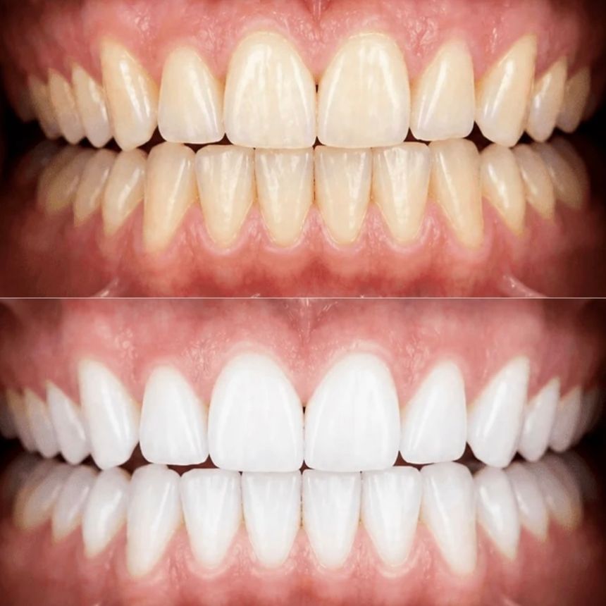 Dentes antes e depois de um branqueamento dentário