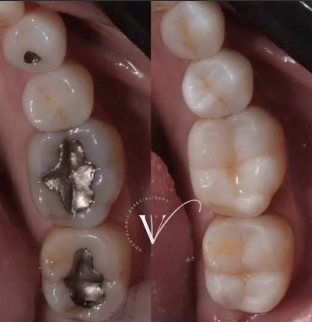 Dentes com amálgamas e cárie antes e restaurados a compósito depois