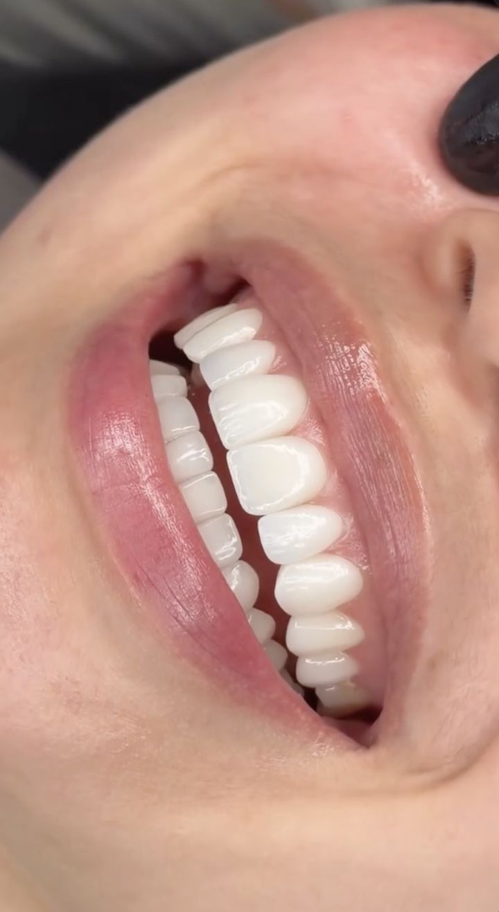 Detalhe de um sorriso com laminados cerâmicos