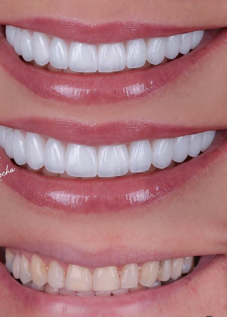 Sorriso antes e depois da colocação de laminados cerâmicos