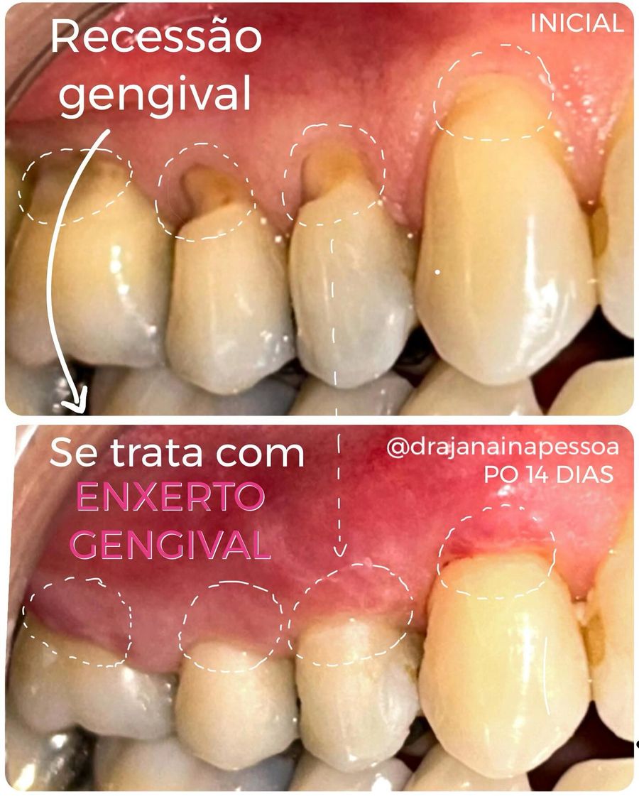 Recessão gengival antes e depois de um enxerto gengival