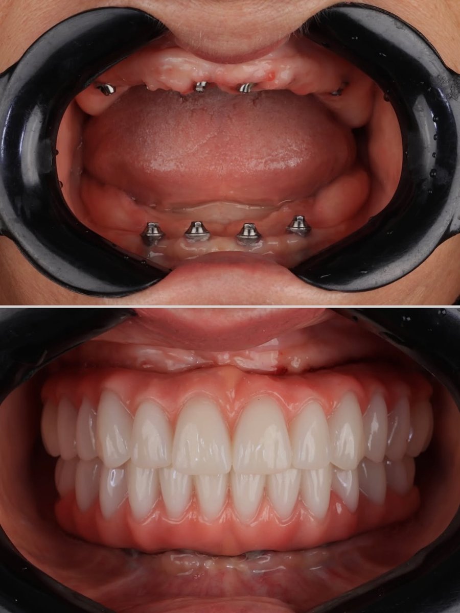 Implantes colocados antes do tratamento e prótese fixa terminada depois